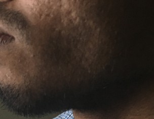 Malocclusion Class 2