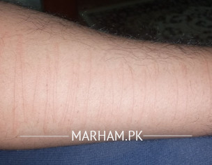 Dermatographia