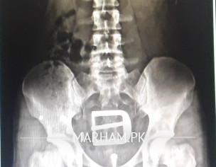 Lower Back Pain