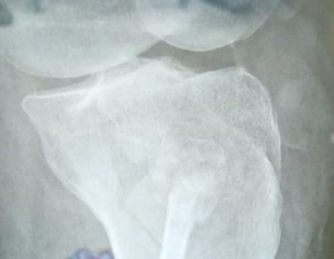 Need Operation Or Plaster