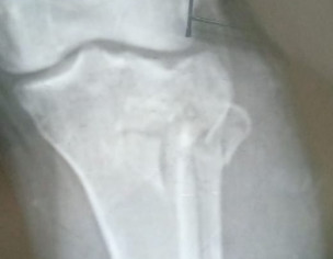 Need Operation Or Plaster