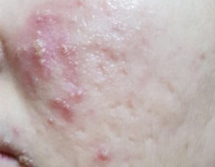 ACTIVE ACNE WITH SCARS