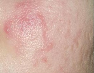 ACTIVE ACNE WITH SCARS