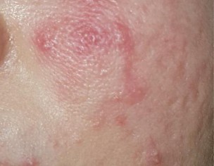 ACTIVE ACNE WITH SCARS