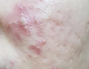 ACTIVE ACNE WITH SCARS