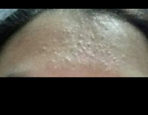 Pimples On Forehead 