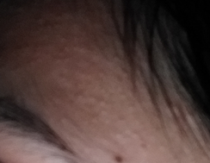 Pimples On Forehead 