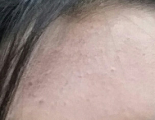 Pimples On Forehead 