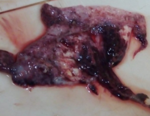 Fibroid Consultation