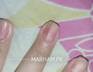 Broken Nail