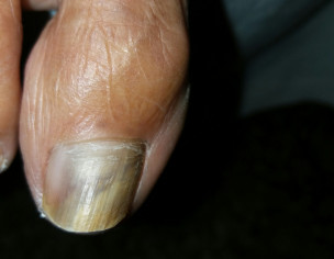 Nail Problem 