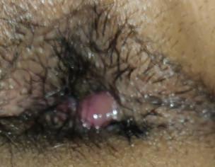 Anus Swelling