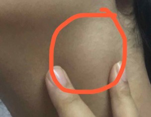 Swelling In The Neck 