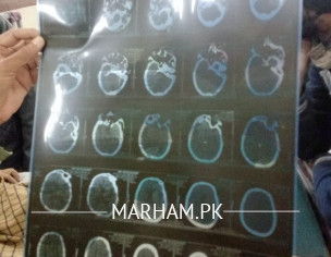 Brain Nd Lungs Prblm