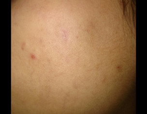 Acne Problm