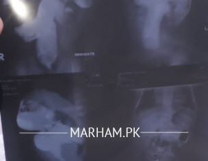 Hirschsprungs Disease