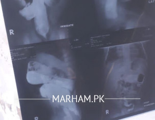 Hirschsprungs Disease