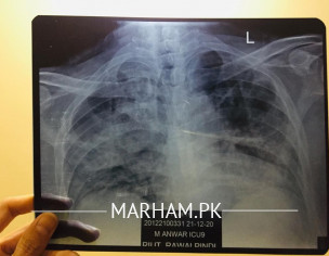 Having To Much Cough