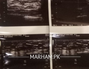 Lump In Right Breast