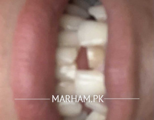 Teeth Problem Frontal Milk Teeth 