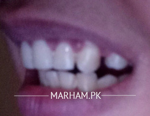 Dentistry: Visible Gap