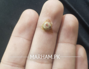 Finger  Issue