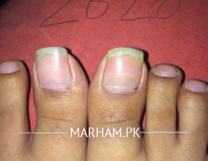 Nail Pain- Beaus Line