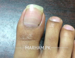 Nail Pain- Beaus Line