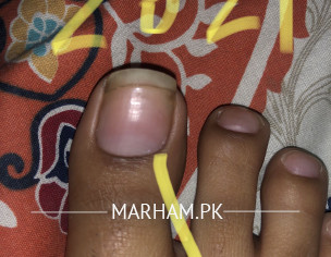 Nail Pain- Beaus Line