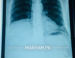 Mulltiple Hepatic Hemangiomas
