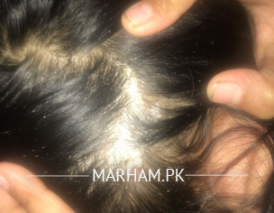 Head Lices And Dermatitis 