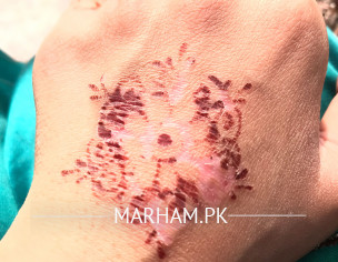 Sensitive Skin Issue ... 