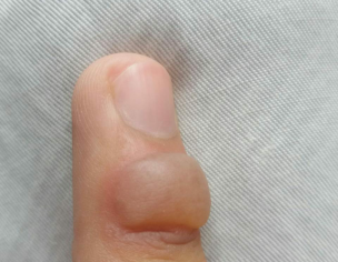 Finger Blister