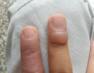 Finger Blister
