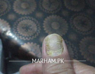 Thumb Infection