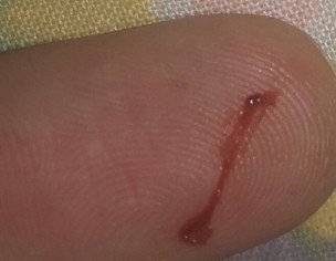 Miscarrige Or Pregnancy