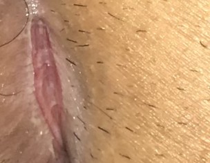 Pilonidal Scar Split/tear