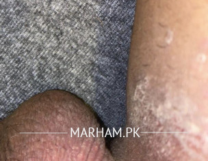 Rash On R Testes And Groin 4 Days