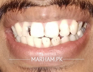 Front Tooth Cavity