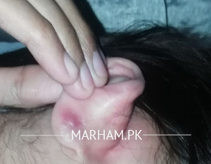 Closed Ear Piercing Infection