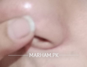 Discoloration Around Nose