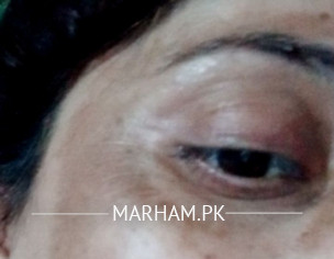 Freckles During Pregnancy