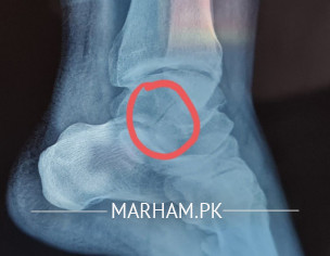 Fracture In Foot
