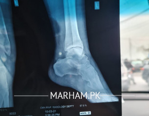 Fracture In Foot