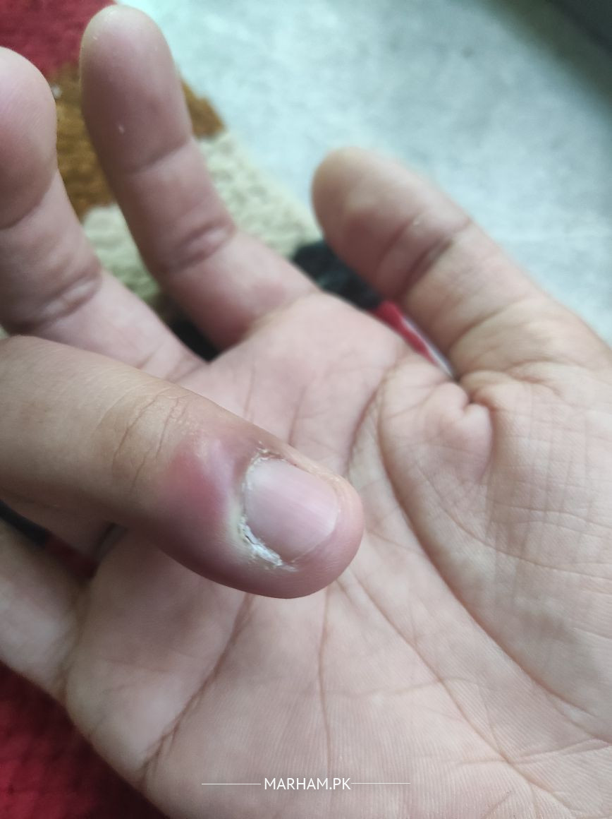 55082 infection swelling on fingernail marham 20