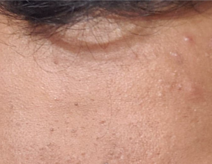 Acne On Face/Forehead