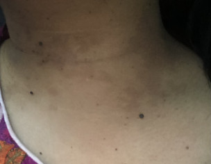 Skin Pigmentation/moles On Neck
