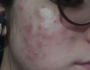 Skin Problem