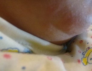 Dryness Nd Pimple Patch