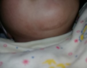 Dryness Nd Pimple Patch